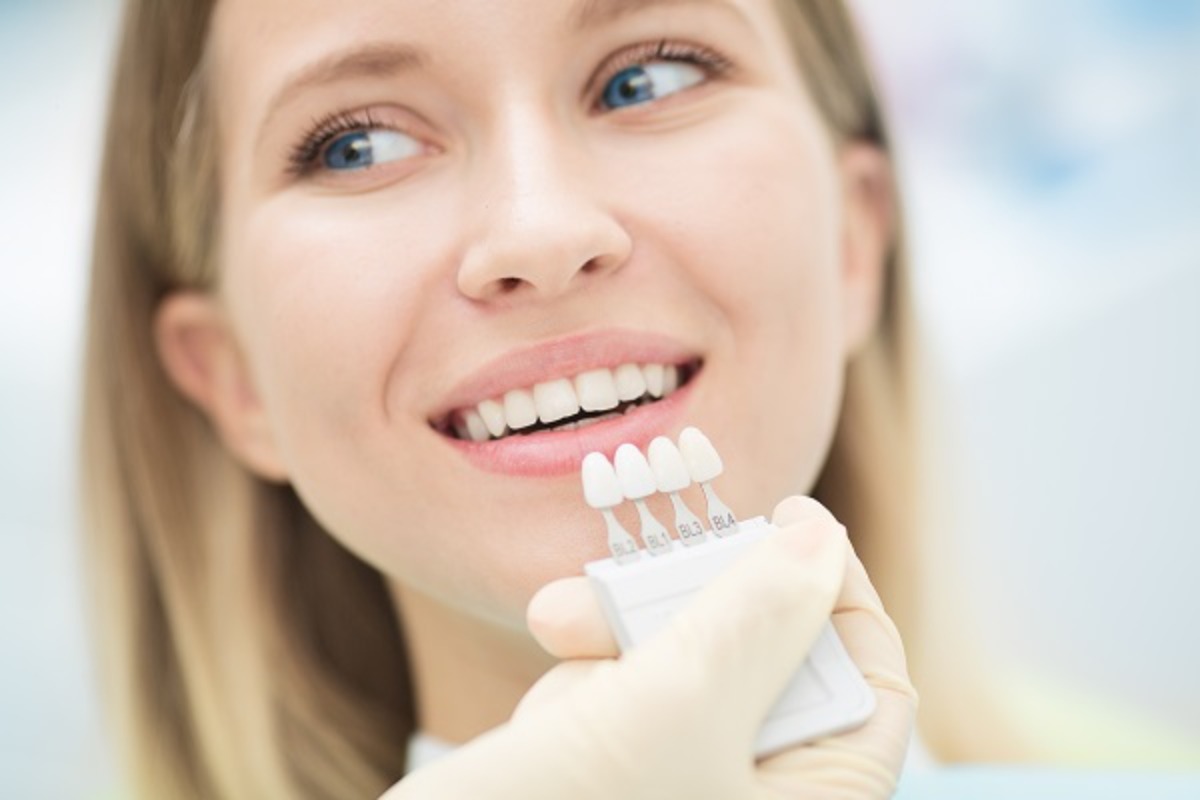 All you need to know about dental veneers